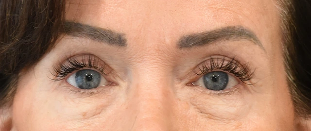 Brow Lift Patient 12 Set 1 After