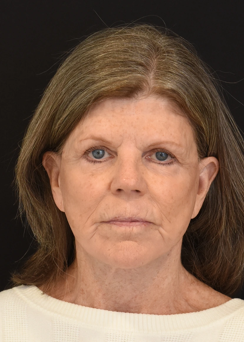 Deep Plane Facelift Patient 29 Set 1 After